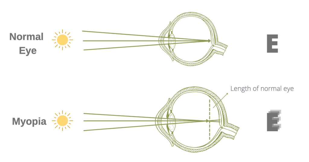 Treating myopia: A comprehensive guide to enhancing eye health