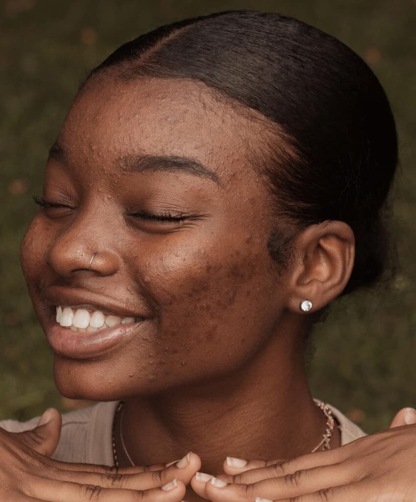 Effective strategies for treating skin pimples