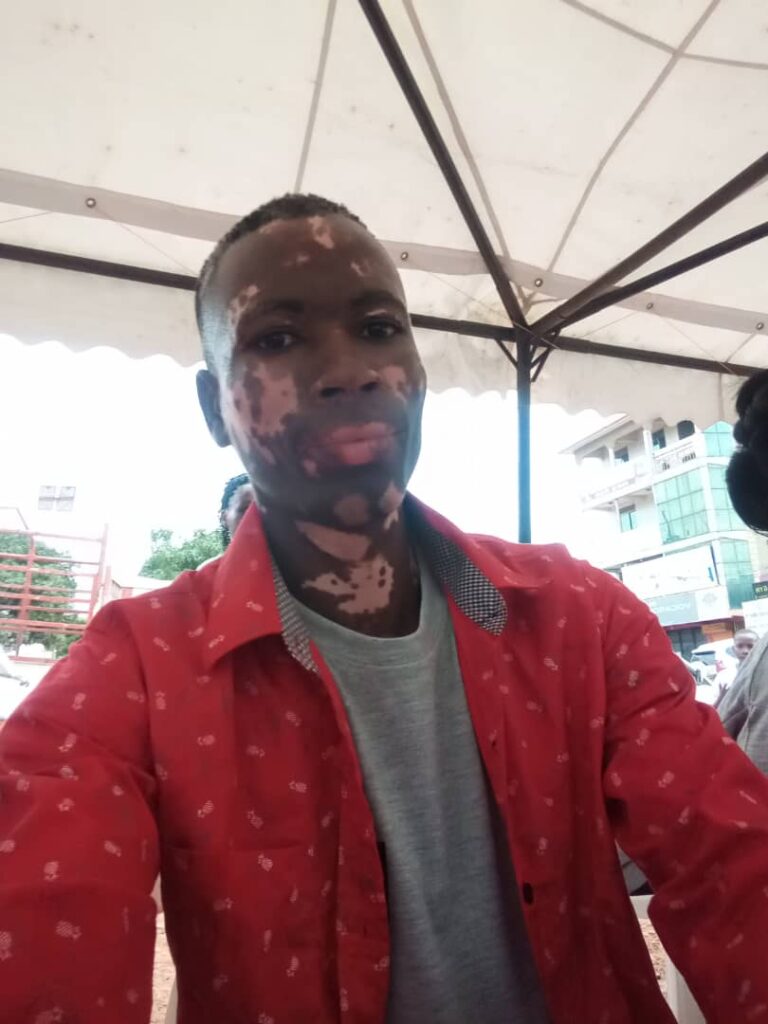 Living with Vitiligo: The challenges and treatment options